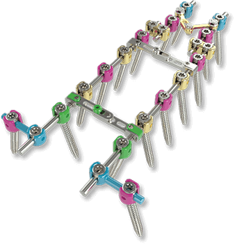 OSI Trabecular Interbody Cage
